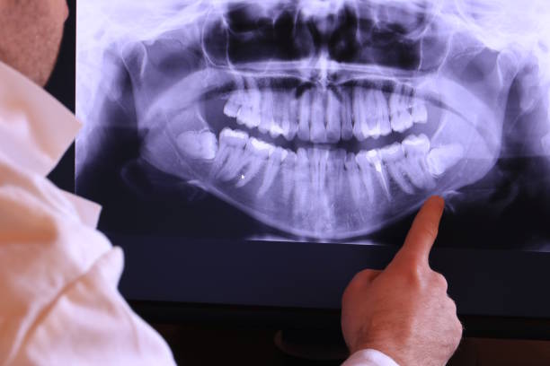 Best Emergency Wisdom Tooth Extraction in Worthington, MN